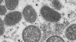 Monkeypox updates: Biden declares public health emergency