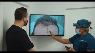 Injerto capilar en Castellana Clinic by Doctor Andrade - Recupera tu pelo de forma definitiva