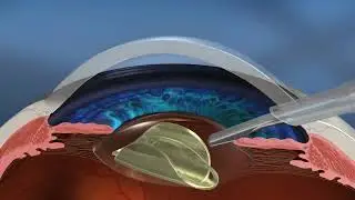 Cirurgia de Catarata a Laser e Convencional