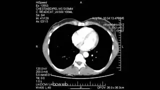 CT Scan of Chest, Abdomen, Pelvis