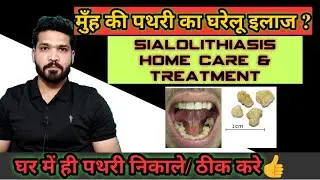 मुँह की पथरी के घरेलु उपाय | Salivary stone Home remedies & care | Sialolithiasis home care