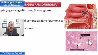 5- Nasopharyngeal Angiofibroma