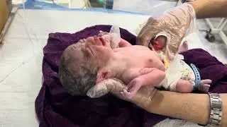27 Week Premature Baby | Good Condition After Birth | Emergency Care & First Cry in NICU #care