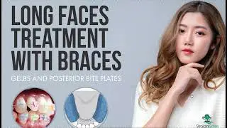 Long Faces, Backwards and Downwards Growth and Braces Dolichocephalic