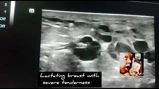 breast abcess with duct ectasia ultrasound by Dr.Haissam Aref, DMS,MSc, MD ultrasound