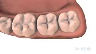 Pit and fissure sealants - Lapointe dental centres