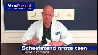 Scheefstand Grote Teen