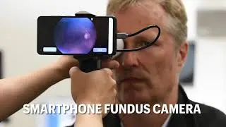 Smartphone Fundus Camera
