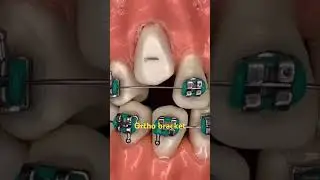How we will put bracket on Canine teeth|canine misplaced|orthodontic treatment|Fixed braces