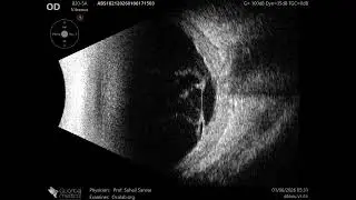 20 MHz Annular Ophthalmic Ultrasound ABSolu, Tractional on retina nasal to disc., 36901