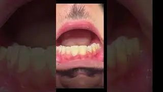 #dental #zahnarzt #veneer #mockup #aesthetic #teeth #dentalrestoration #zahnmedizin #dentist #team