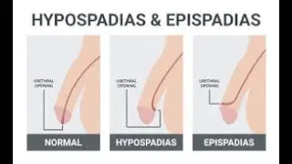 Epispadias And Hypospadias; congenital malformations of the urethra affecting males