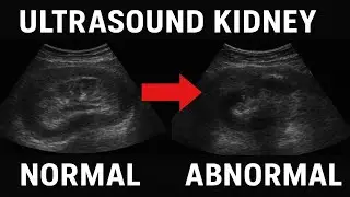 Ultrasound kidney Normal vs abnormal! Ultrasound showing renal parenchymal diseases!#viralvideo#uk 