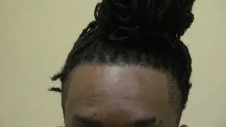 Black African American Advance Hair Loss Hair Transplant Restoration Surgery Result with Dr. Diep
