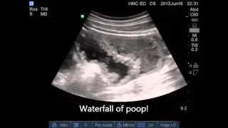 Bedside Emergency Ultrasound Case: Small Bowel Obstruction