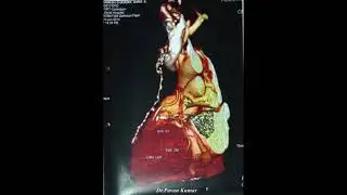 14 Year Long Term Follow Up of CABG