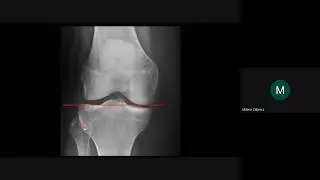 Anatomía por Imágenes de la Rodilla.