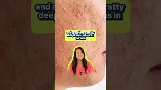 Are those acne scars or is it just hyperpigmentation? 👆️⁠⁠