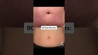 90 day results ✨ #stretchmarks #postpartum