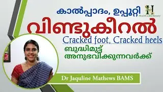 കാൽപ്പാദം വിണ്ടുകീറൽ ഉള്ളവർക്ക്.. | Cracked feet, Cracked heels | Dr Jaquline Mathews BAMS