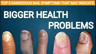 5 Nail Symptoms & Signs telling that You Have a Serious health Problems
