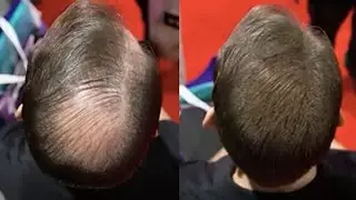 #1 Most Effective Hairloss Solution -- Works for both Men and Women!