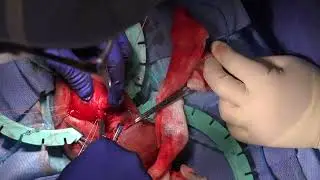 Californian's Penile Implant Revision   Multiple Points of Failure