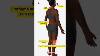 3D Concept Sprint 🚀 Lyme Disease &ndash; Tick-borne Bacterial Infection (Borrelia burgdorferi)