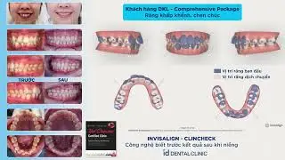 Răng khấp khểnh - Chen ch&uacute;c|  Invisalign ClinCheck id Dental Clinic
