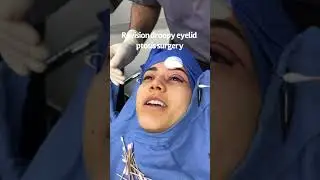 Revision Droopy Eyelid Surgery / Droopy Eyelids