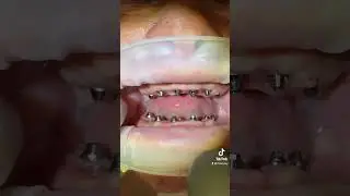 Go ahead and tag @Thebentist 😅 | Multiunit Abutments on Dental Implants - No Teeth #aprilfools