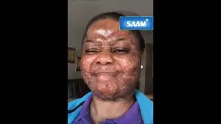 Watch her amazing skin transformation journey from freckled face to smooth with SAAM! #skincare