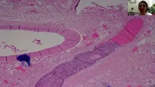 Tip-1; Lymphovascular vs. Venous Invasion