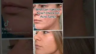 What can I Take for Acne? | Acnetame Testimonials