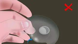 Complication  of Using Nipple Shields- English