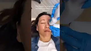 Tightening the lower eyelids with #thermage #over50 #skincare