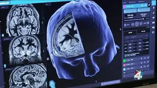 Doctor explains how to &lsquo;Be Fast,&rsquo; recognize critical stroke signs