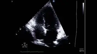 Large RA Mass Case