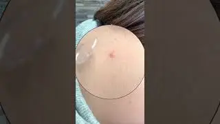 #howto Zap Pimple Faster Using High Frequency | Esthetician Tutorial #mychwaybeauty