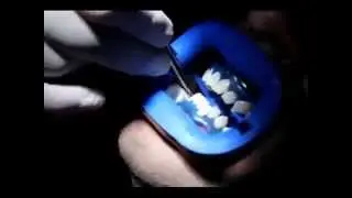 Tẩy Trắng Răng bằng c&ocirc;ng nghệ BriteSmile