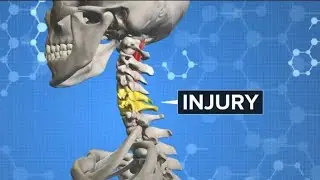 New technology helps paralyzed people walk again