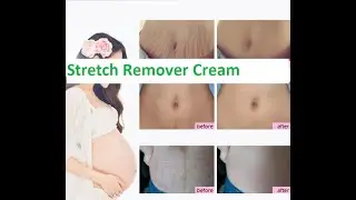 Pregnant Stretch Remover