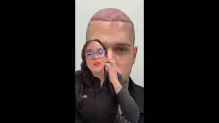 Transplante Capilar - Consulta Totalmente Gratis