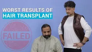 Hair Transplant Gone Wrong? Shocking Fails & What You Need to Know! | Pakistan Best JJ Aesthetics