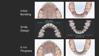 Treating Premolar Extraction with InBrace