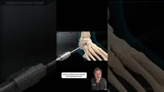 How To Fix Flat Foot- Dr. Bernstein