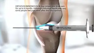 ORTHOVISC&reg;/MONOVISC&reg; Injection Animation