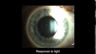 Adie's pupil