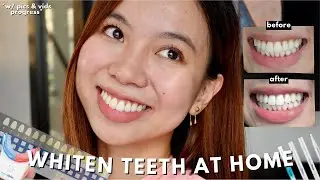 Tried the HydroWhite Home Teeth Whitening System All-in-One Kit for a week*effective*/before & after