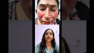 Topical steroid damaged face ( TSDF)